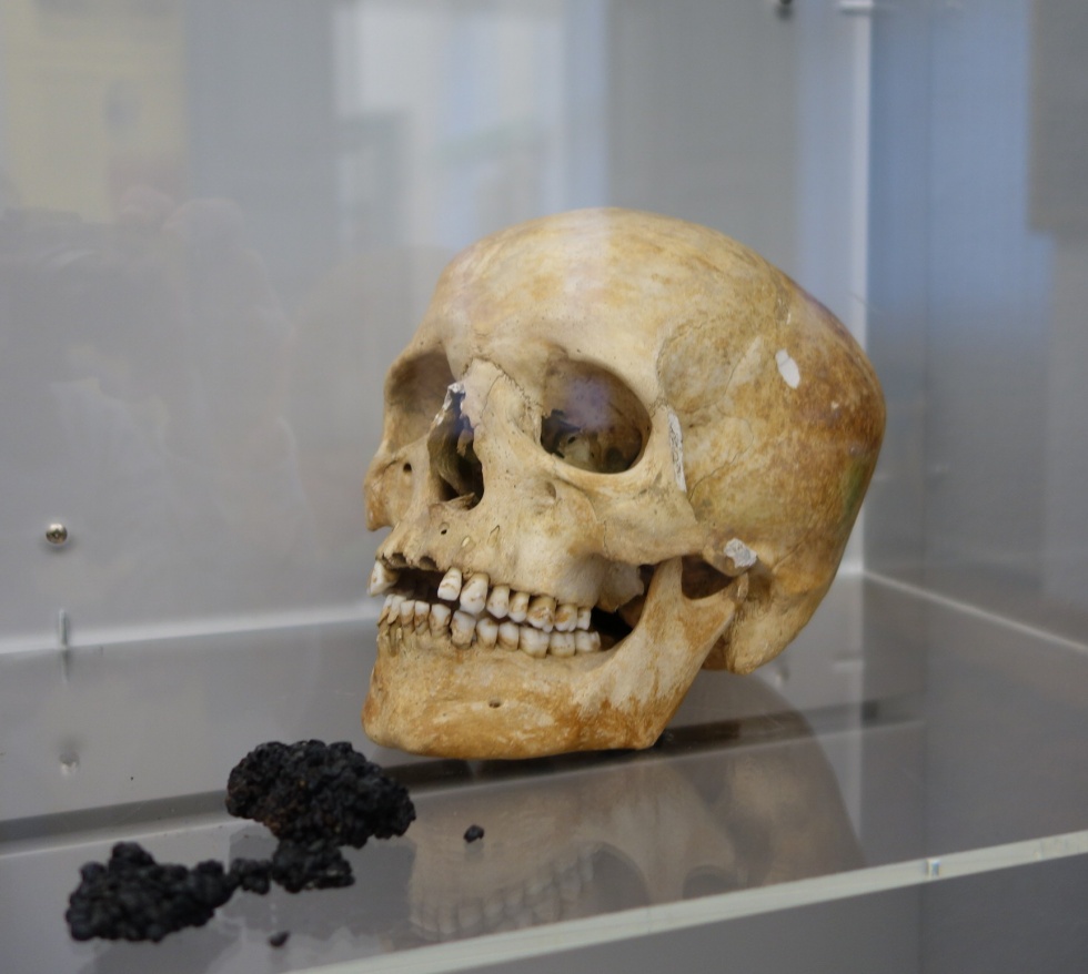 Schädel eines Mannes (Pfinzgaumuseum in der Karlsburg CC BY-NC-SA)