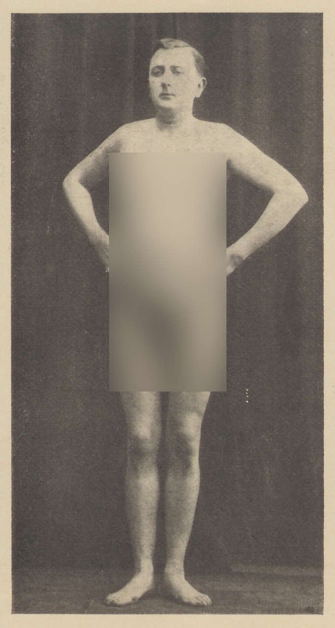 Fotografie einer zu Musterung in Trauerkleidung erschienenen Person (hier unbekleidet) (2) (Magnus-Hirschfeld-Gesellschaft Public Domain Mark)