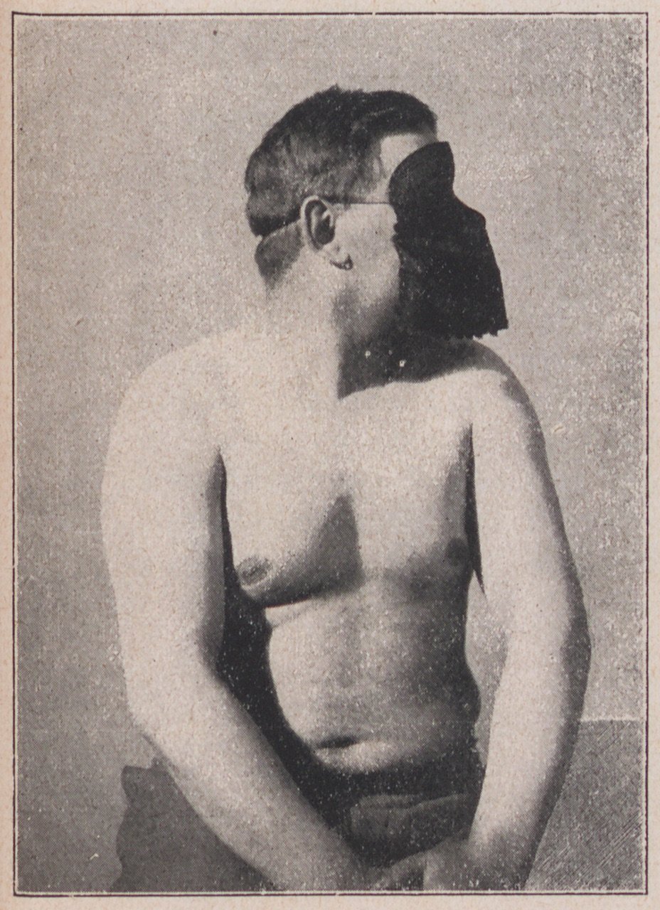 Fotografie, die einen 28 jährigen Patienten zeigt (Magnus-Hirschfeld-Gesellschaft Public Domain Mark)