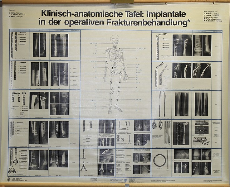 Lehrtafel Implantate Frakturbehandlung (Krankenhausmuseum Bielefeld e.V. CC BY-NC-SA)