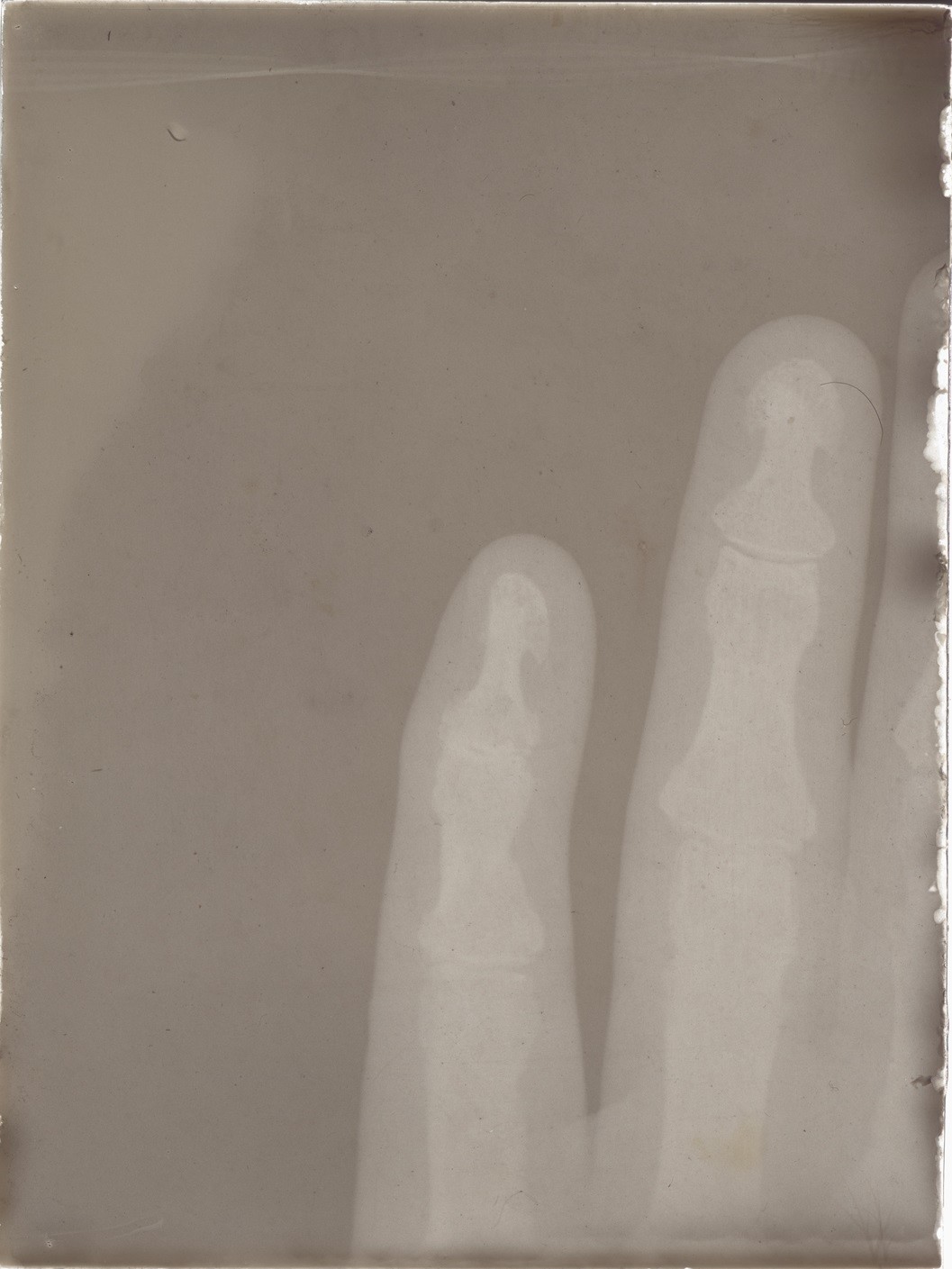 Versuch: Röntgenaufnahme einer Hand (06.06.1896), 86354 gp (Deutsches Röntgen-Museum CC BY-NC-SA)