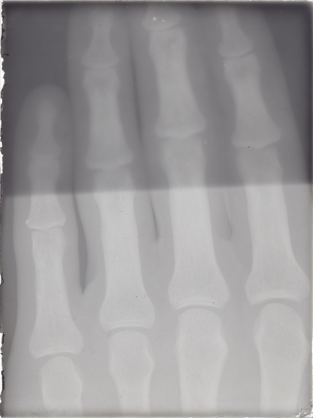 Versuch: Röntgenaufnahme einer Hand (Mai-Juli 1896), 86358 gp (Deutsches Röntgen-Museum CC BY-NC-SA)