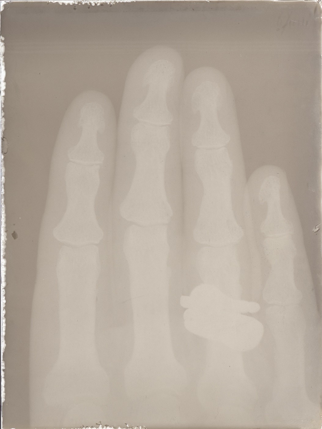 Versuch: Röntgenaufnahme einer Hand (06.06.1896), 86359 gp (Deutsches Röntgen-Museum CC BY-NC-SA)
