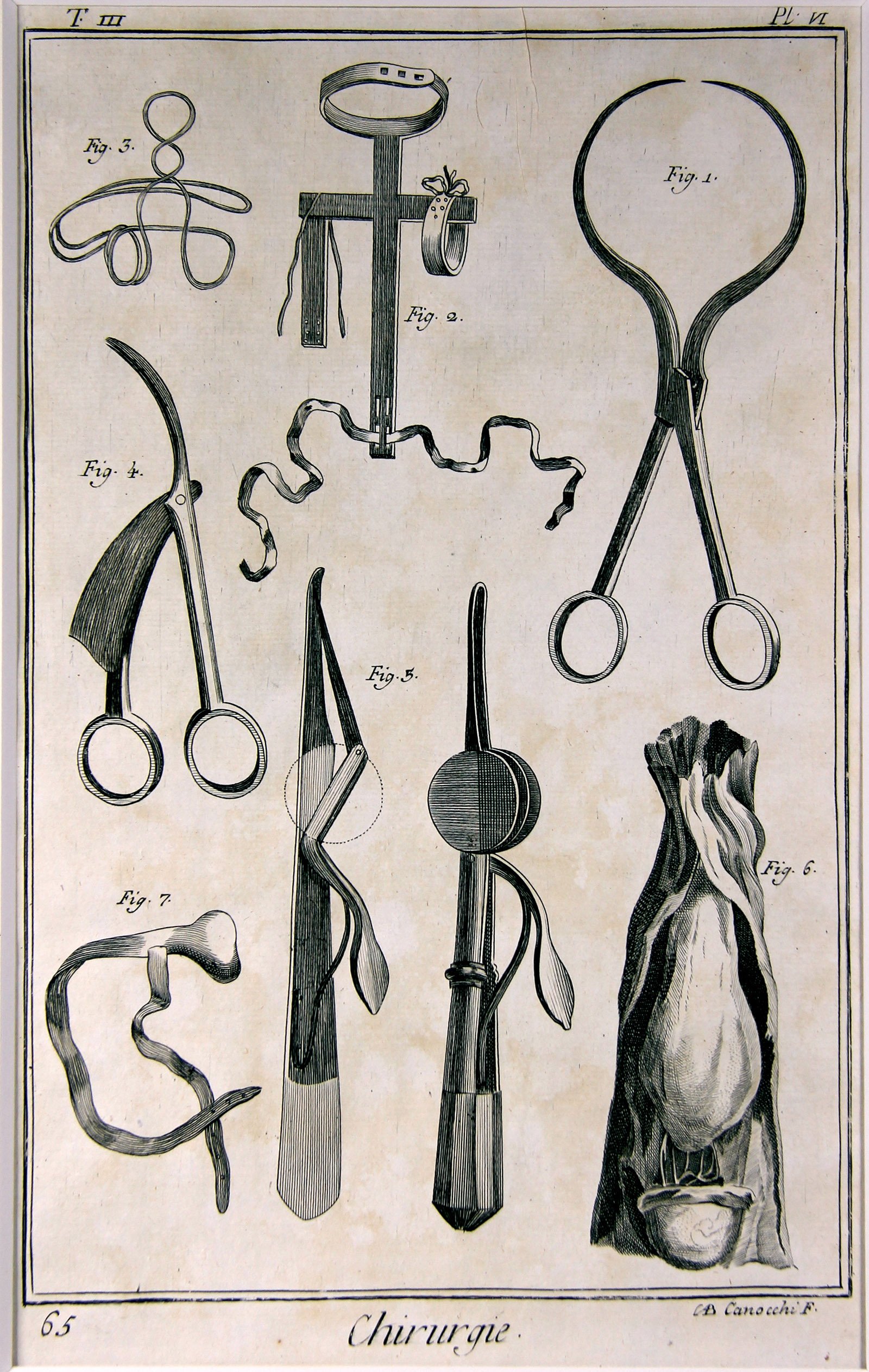 Chirurgie, Pl. 06 (Wilhelm-Fabry-Museum CC BY-NC-SA)