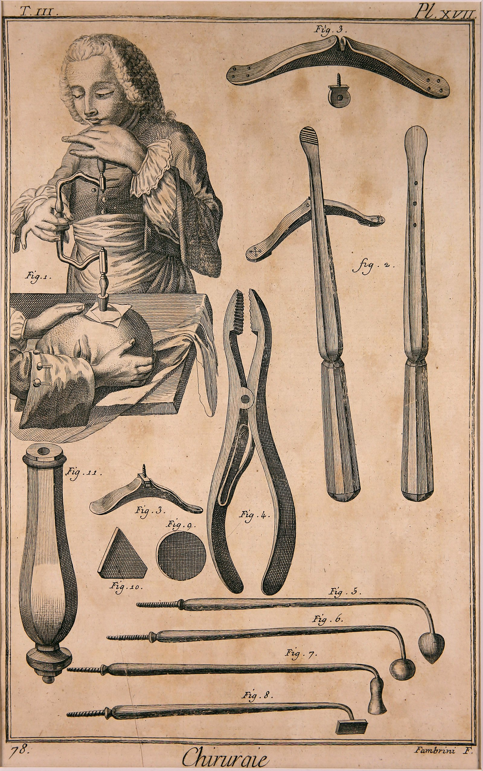 Chirurgie, Pl. 17 (Wilhelm-Fabry-Museum CC BY-NC-SA)