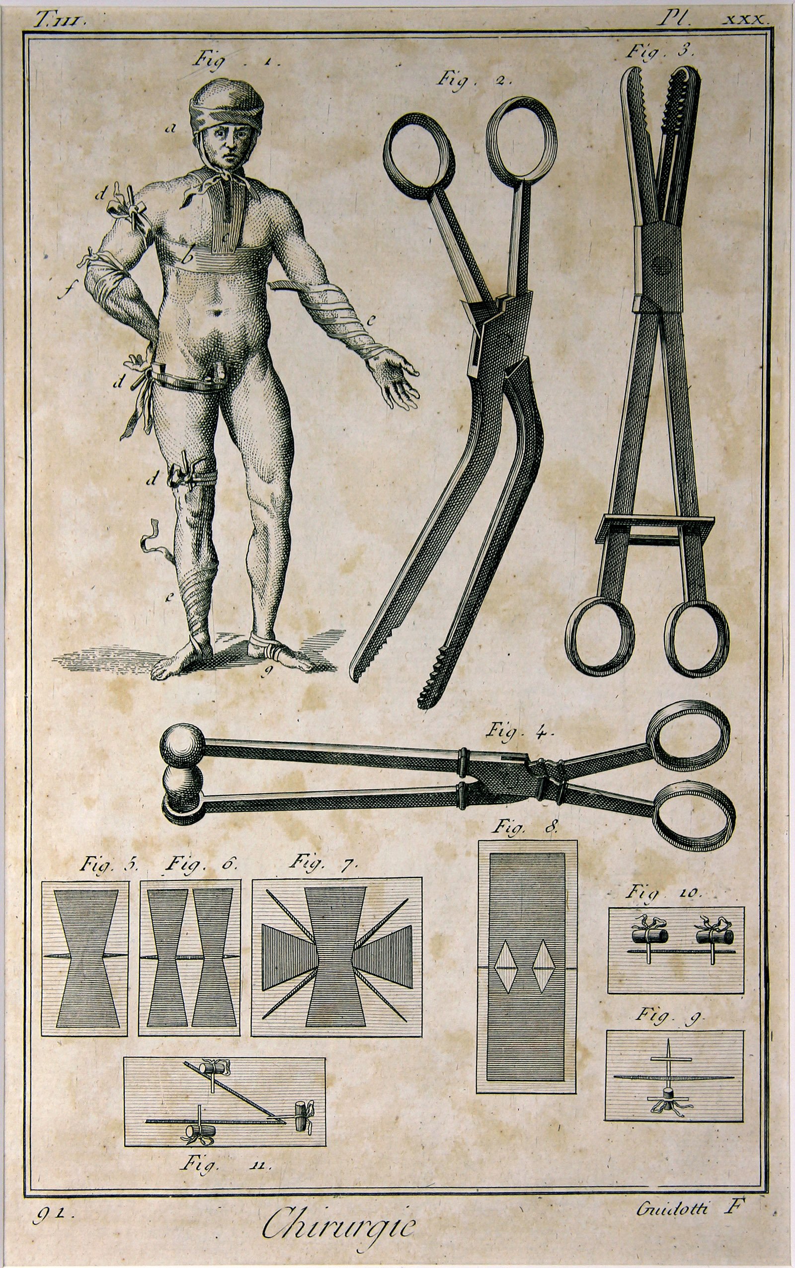 Chirurgie, Pl. 30 (Wilhelm-Fabry-Museum CC BY-NC-SA)