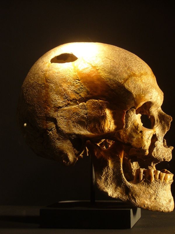Schädel eines Mannes in der Jungsteinzeit (Städtische Museen Quedlinburg/Schlossmuseum CC BY-NC-SA)